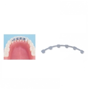 Lingual Retainer Maxillary